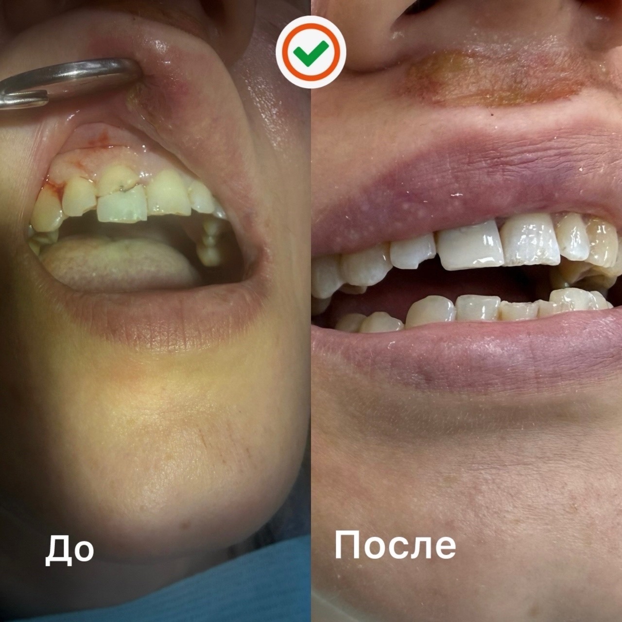 Реставрация передних зубов после травмы — до и после